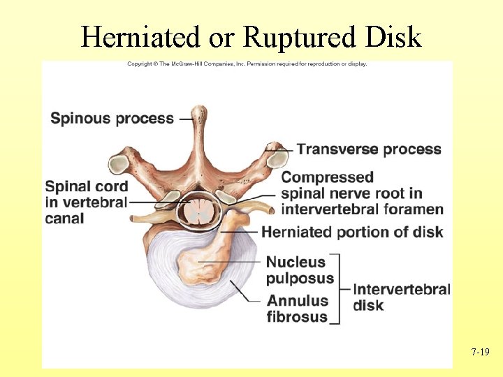 Herniated or Ruptured Disk 7 -19 