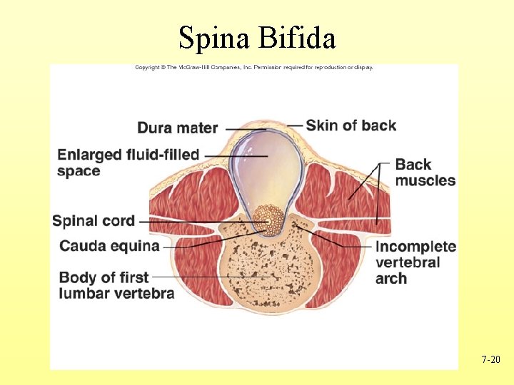 Spina Bifida 7 -20 