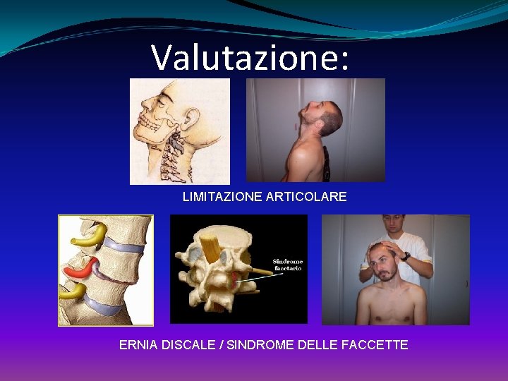 Valutazione: LIMITAZIONE ARTICOLARE ERNIA DISCALE / SINDROME DELLE FACCETTE 