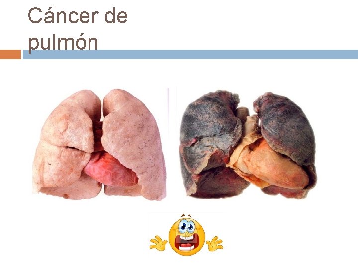 Cáncer de pulmón 