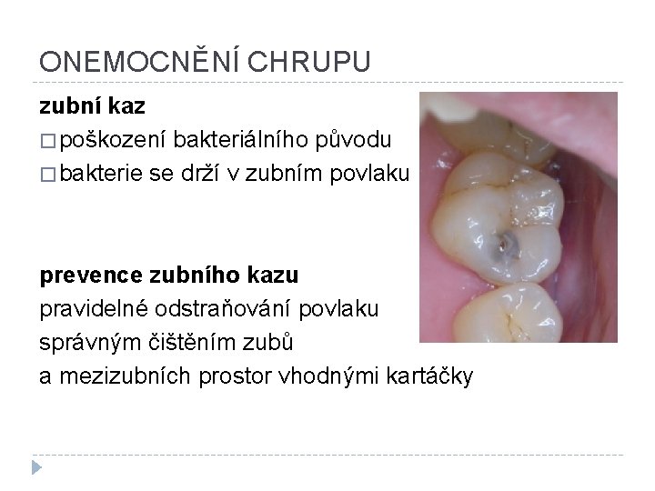 ONEMOCNĚNÍ CHRUPU zubní kaz � poškození bakteriálního původu � bakterie se drží v zubním