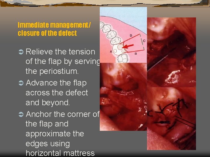 Immediate management/ closure of the defect Ü Relieve the tension of the flap by