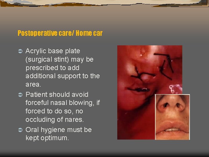 Postoperative care/ Home car Acrylic base plate (surgical stint) may be prescribed to additional