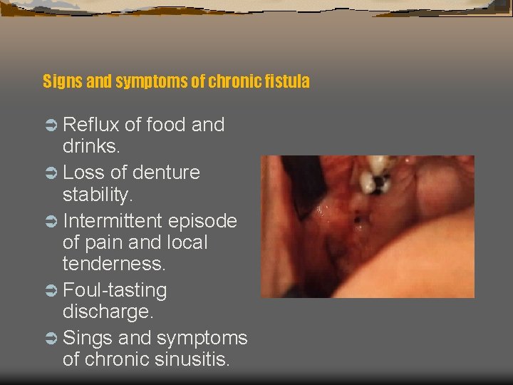 Signs and symptoms of chronic fistula Ü Reflux of food and drinks. Ü Loss