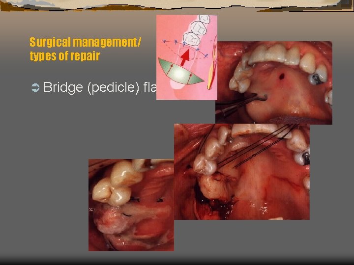 Surgical management/ types of repair Ü Bridge (pedicle) flap 