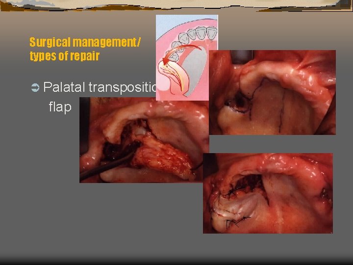 Surgical management/ types of repair Ü Palatal flap transposition 