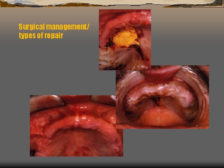 Surgical management/ types of repair 