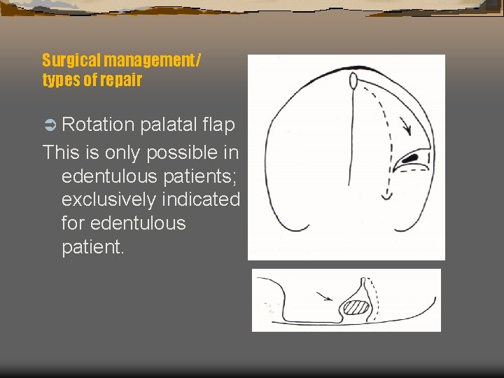 Surgical management/ types of repair Ü Rotation palatal flap This is only possible in