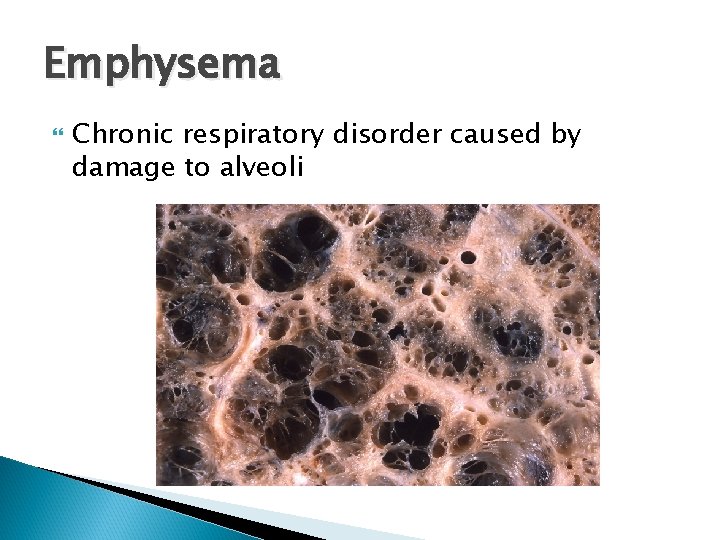 Emphysema Chronic respiratory disorder caused by damage to alveoli 