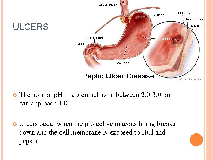 ULCERS The normal p. H in a stomach is in between 2. 0 -3.