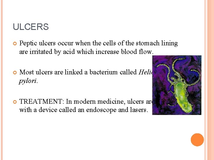 ULCERS Peptic ulcers occur when the cells of the stomach lining are irritated by