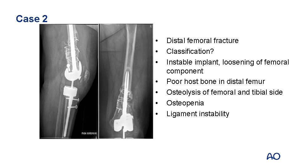 Case 2 • • Distal femoral fracture Classification? Instable implant, loosening of femoral component