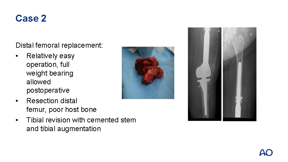 Case 2 Distal femoral replacement: • Relatively easy operation, full weight bearing allowed postoperative