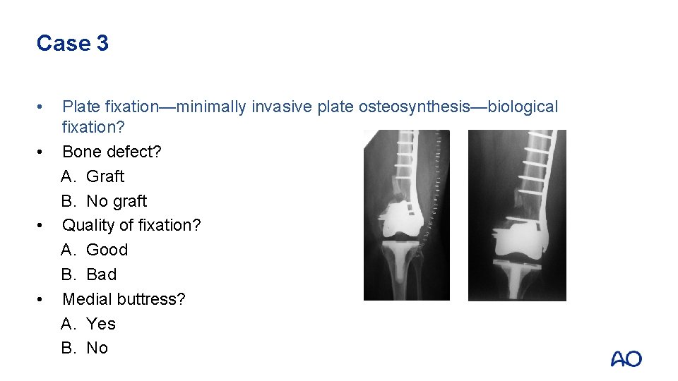 Case 3 • • Plate fixation—minimally invasive plate osteosynthesis—biological fixation? Bone defect? A. Graft
