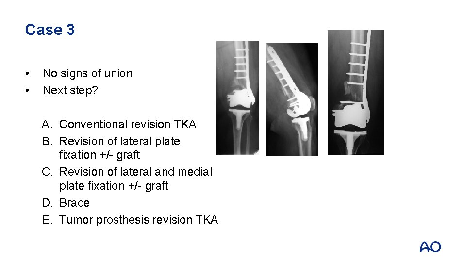 Case 3 • • No signs of union Next step? A. Conventional revision TKA