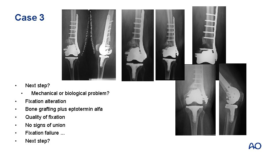 Case 3 • Next step? • • Mechanical or biological problem? Fixation alteration Bone