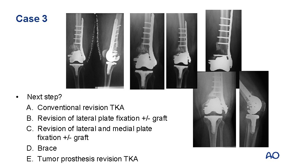 Case 3 • Next step? A. Conventional revision TKA B. Revision of lateral plate