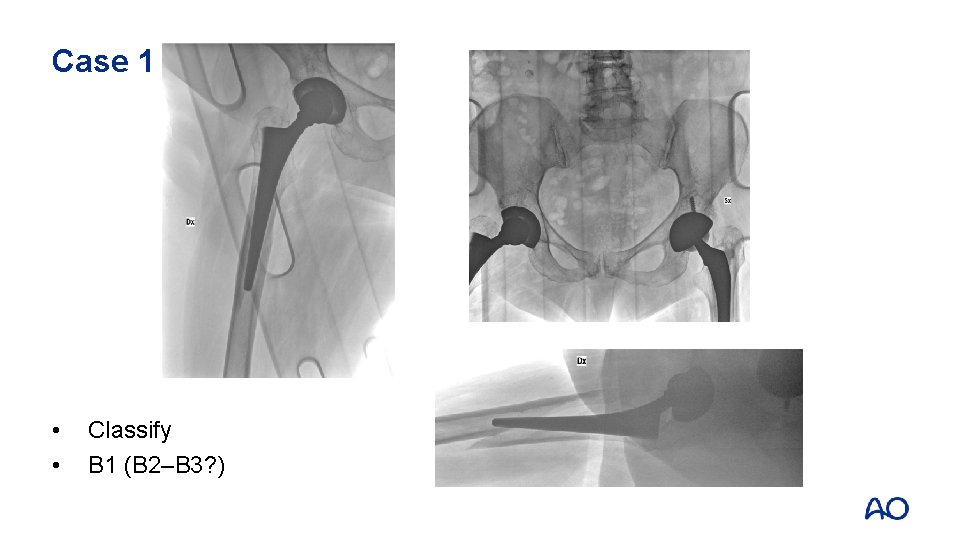 Case 1 • • Classify B 1 (B 2–B 3? ) 