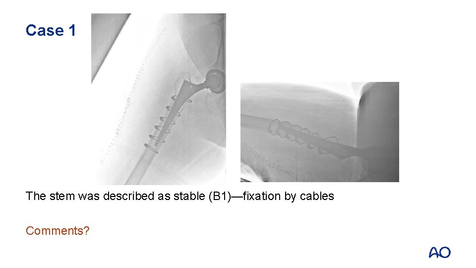 Case 1 The stem was described as stable (B 1)—fixation by cables Comments? 