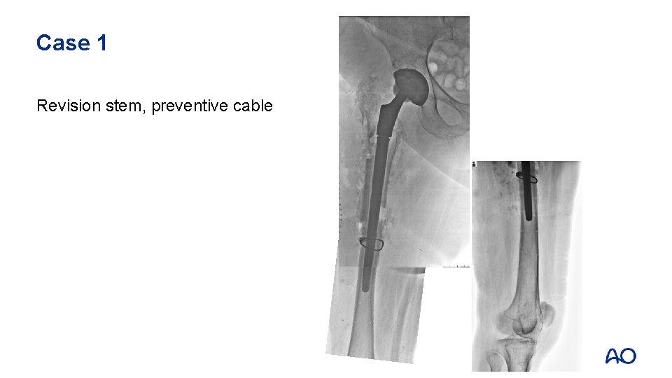 Case 1 Revision stem, preventive cable 