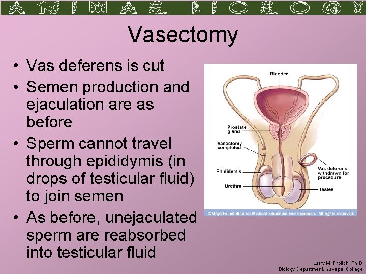 Vasectomy • Vas deferens is cut • Semen production and ejaculation are as before