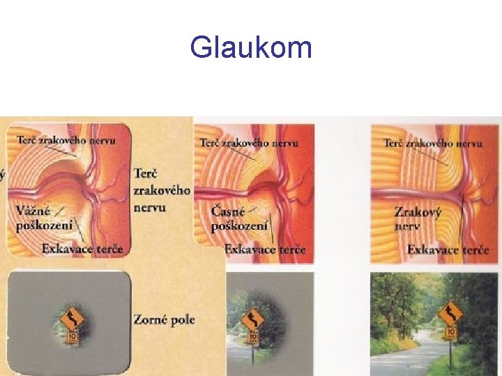 Glaukom 