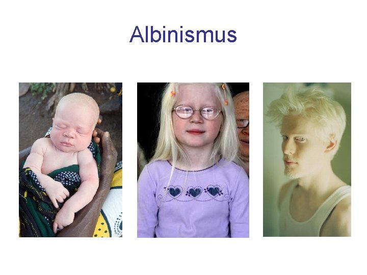 Albinismus 