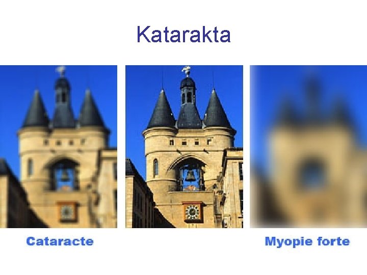 Katarakta 