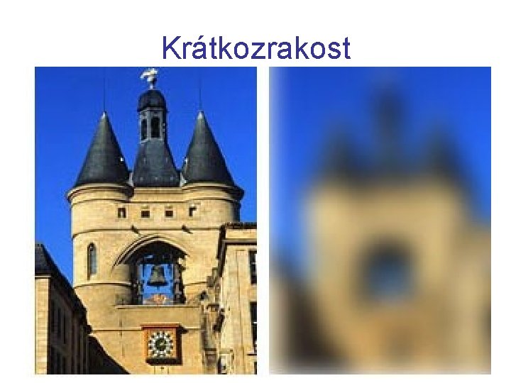 Krátkozrakost 