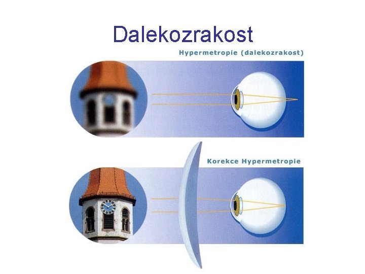 Dalekozrakost 