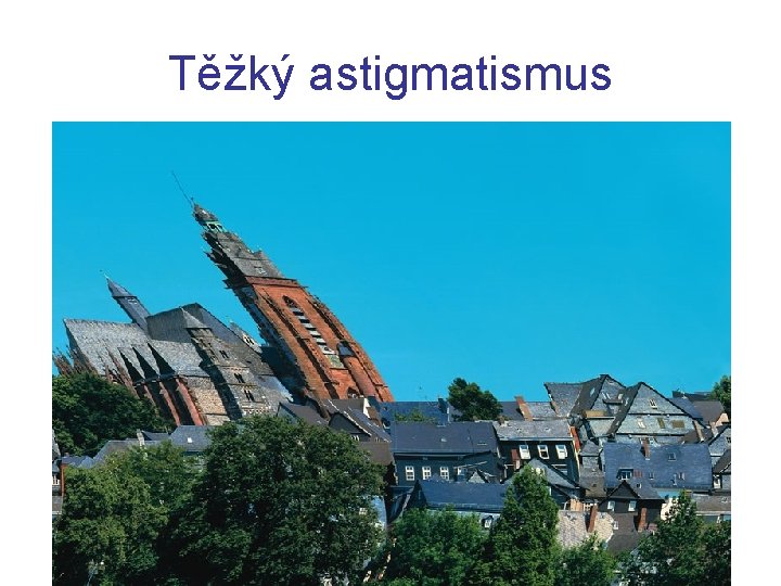 Těžký astigmatismus 