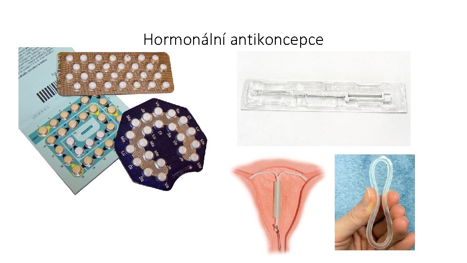 Hormonální antikoncepce 
