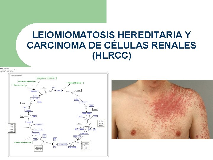 LEIOMIOMATOSIS HEREDITARIA Y CARCINOMA DE CÉLULAS RENALES (HLRCC) 