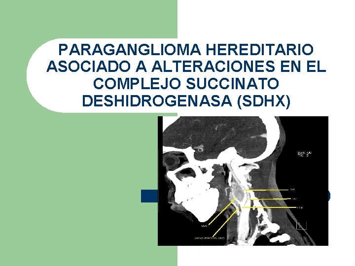 PARAGANGLIOMA HEREDITARIO ASOCIADO A ALTERACIONES EN EL COMPLEJO SUCCINATO DESHIDROGENASA (SDHX) 