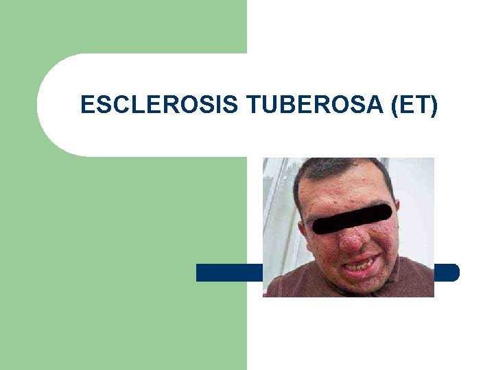 ESCLEROSIS TUBEROSA (ET) 