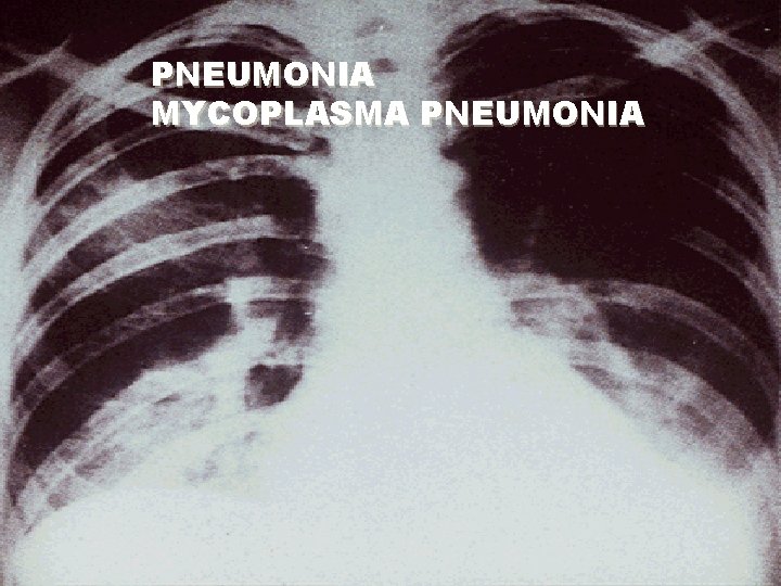 PNEUMONIA MYCOPLASMA PNEUMONIA 