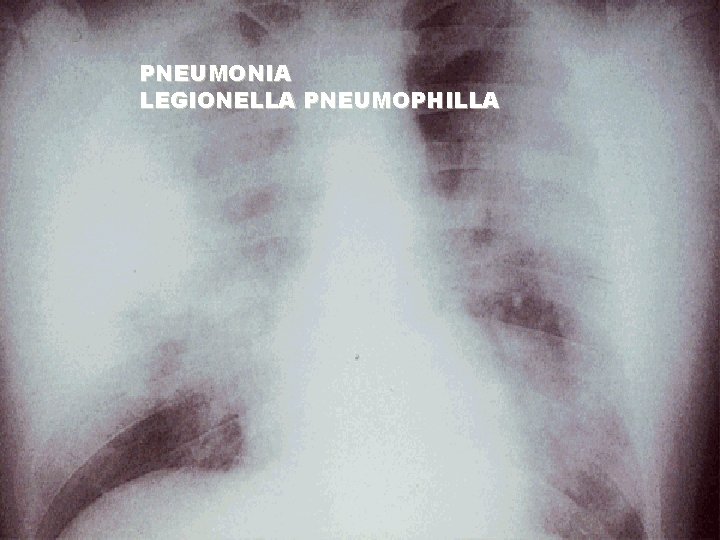 PNEUMONIA LEGIONELLA PNEUMOPHILLA 