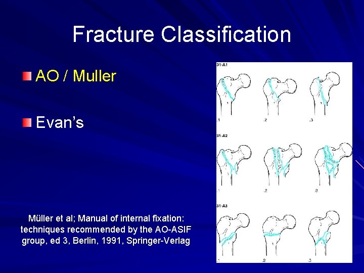 Fracture Classification AO / Muller Evan’s Müller et al; Manual of internal fixation: techniques