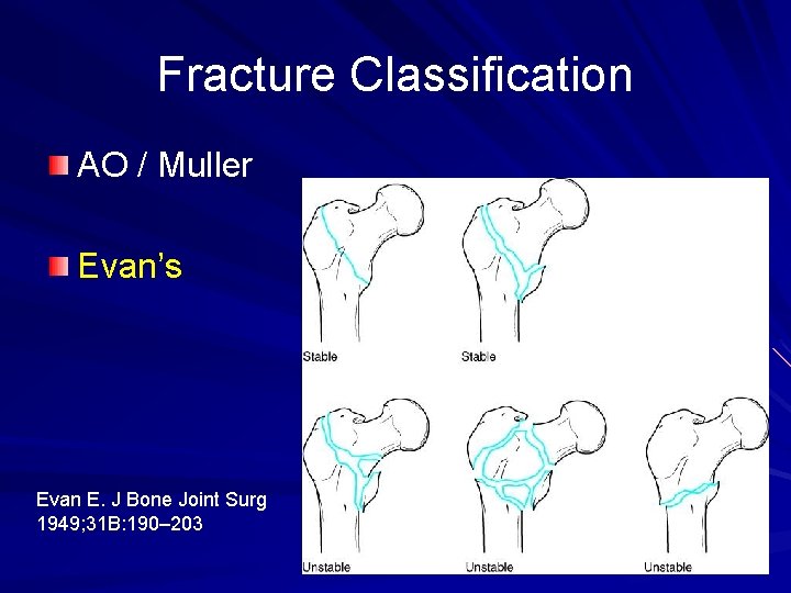 Fracture Classification AO / Muller Evan’s Evan E. J Bone Joint Surg 1949; 31