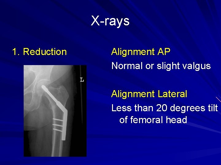 X-rays 1. Reduction Alignment AP Normal or slight valgus Alignment Lateral Less than 20