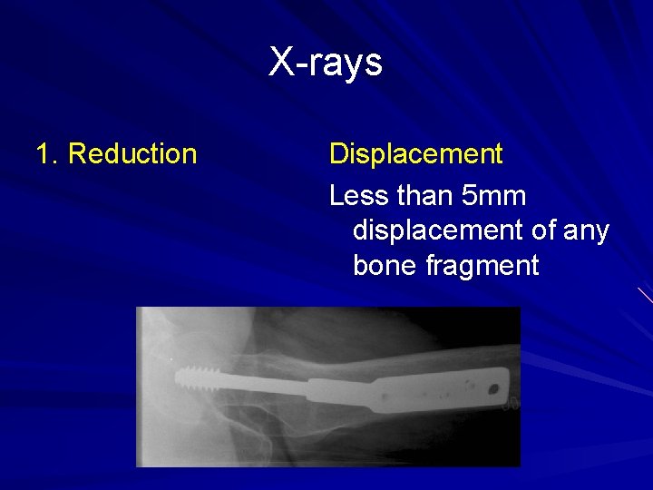 X-rays 1. Reduction Displacement Less than 5 mm displacement of any bone fragment 