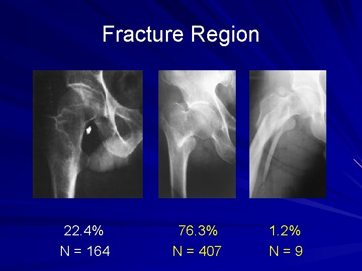 Fracture Region 22. 4% N = 164 76. 3% N = 407 1. 2%