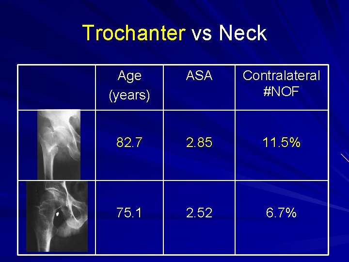 Trochanter vs Neck Age (years) ASA Contralateral #NOF 82. 7 2. 85 11. 5%