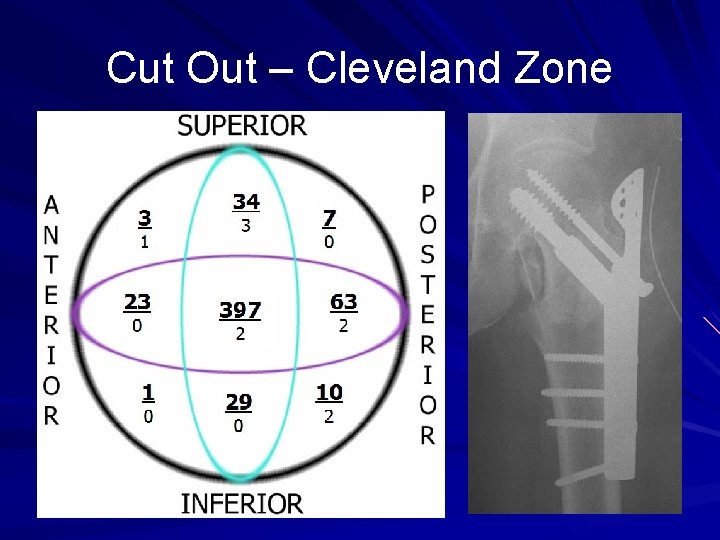 Cut Out – Cleveland Zone 