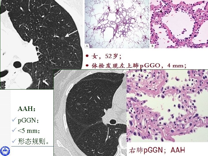 LUNG NODULE AAH： ü p. GGN； ü <5 mm； ü 形态规则。 