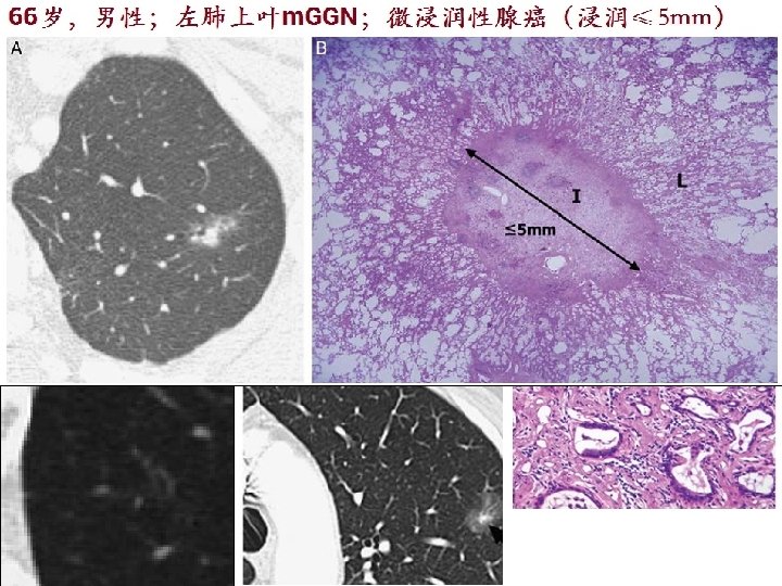 LUNG NODULE 