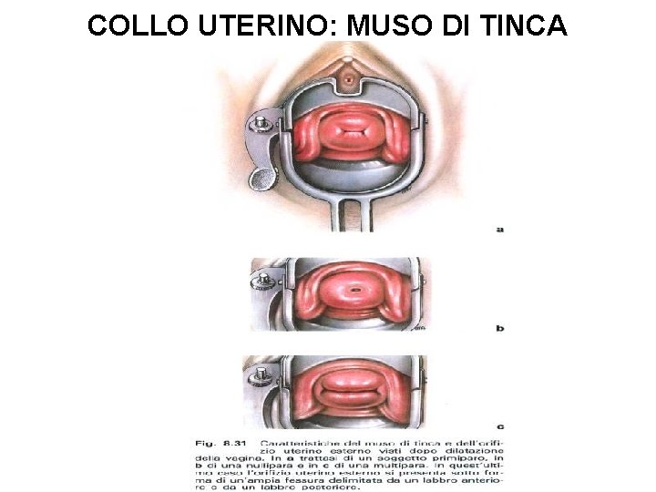 COLLO UTERINO: MUSO DI TINCA 