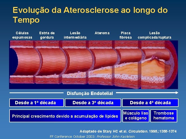 Evolução da Aterosclerose ao longo do Tempo Células espumosas Estria de gordura Lesão intermediária