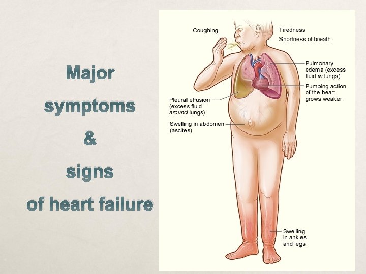 Major symptoms & signs of heart failure 