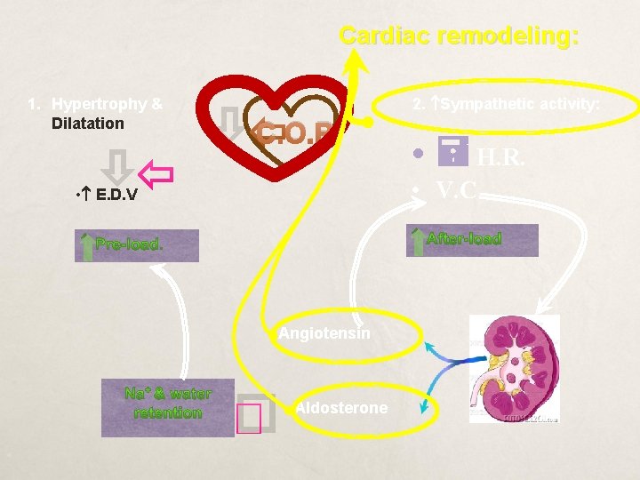 Cardiac remodeling: 1. Hypertrophy & Dilatation C. O. P 2. Sympathetic activity: • H.